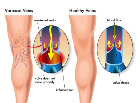 How Does Being Constipated Promote Varicose Veins?
