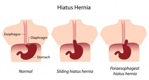 Is GERD a Symptom of a Hiatal Hernia?