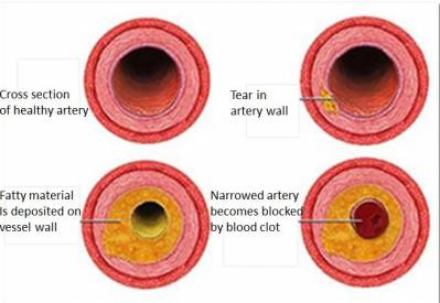 Atherosclerosis Begins in Early Childhood