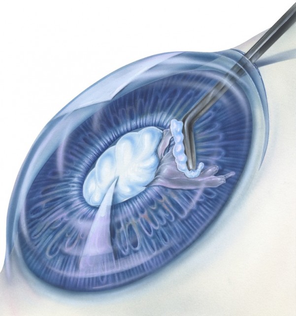 Cataract With Surgical Instrument