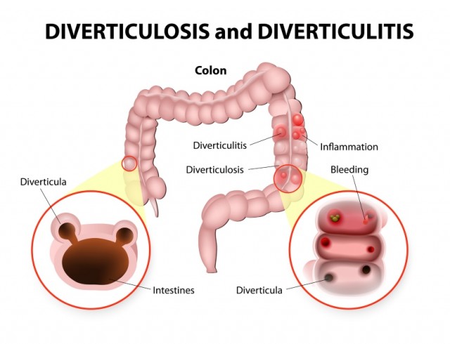 Diverticulitis and Happy Endings