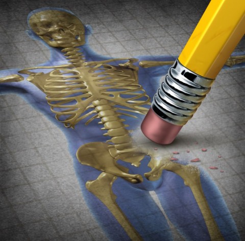 Osteoporosis: Bone Being Erased From Skeleton