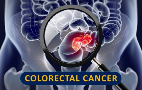 Colorectal Cancer Illustration