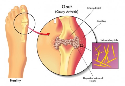 Gouty Arthritis Uric Acid Crystals