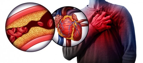 Reduce Your Risk of Clogged Arteries Leading to Heart Failure