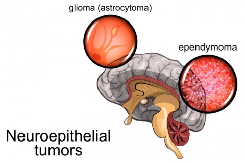 Neuroepithelial Tumors