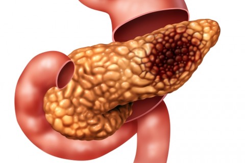 Pancreatic Cancer Illustration