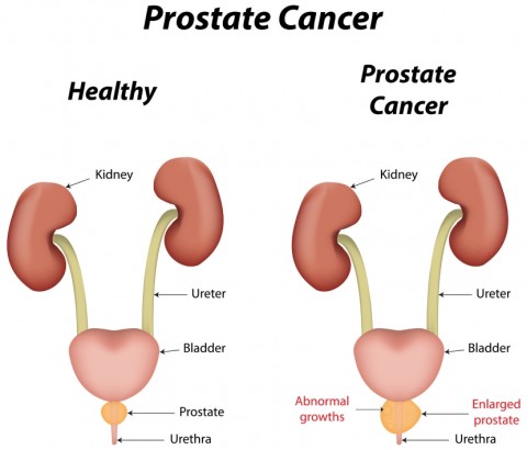 Using Diet to Help Prevent Prostate Cancer