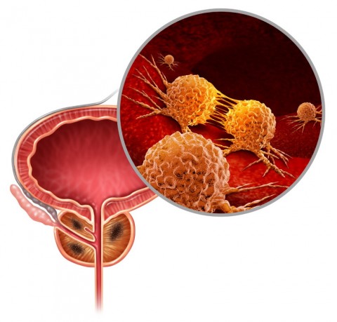 Prostate Cancer Cells Illustration