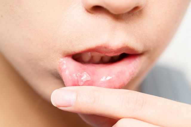 Could Mouth Ulcers be Caused by Dairy?